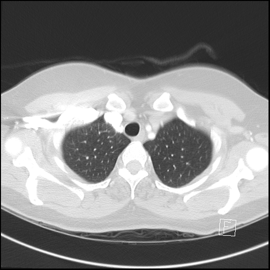 File:Breast metastases from renal cell cancer (Radiopaedia 79220-92225 Axial lung window 12).jpg
