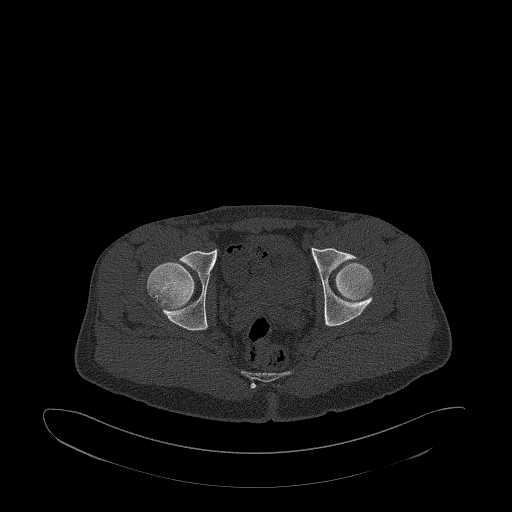 Brodie abscess- femoral neck (Radiopaedia 53862-59966 Axial bone window 136).jpg