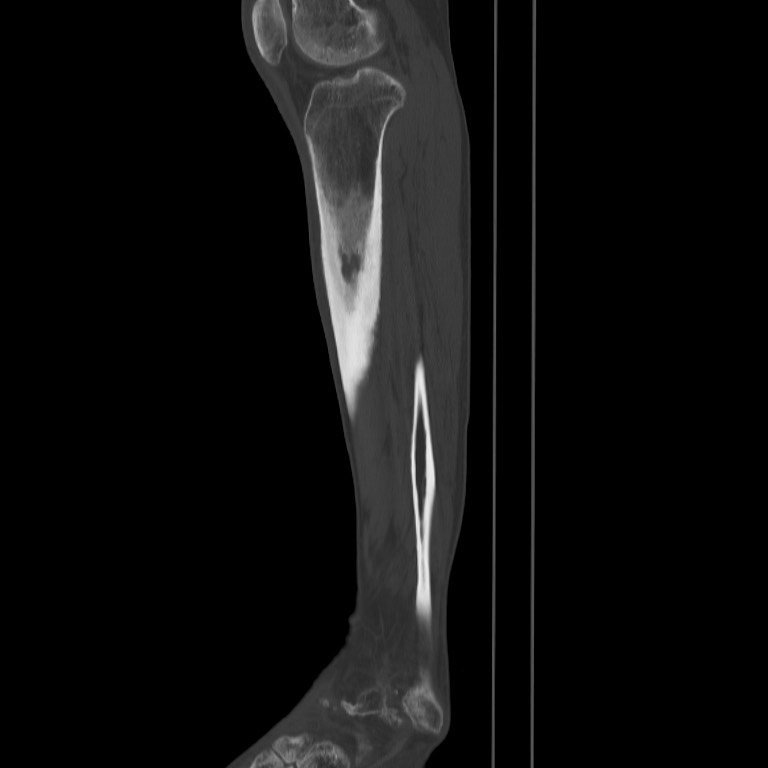 Brodie abscess - tibia (Radiopaedia 66028-75204 Sagittal bone window 49).jpg