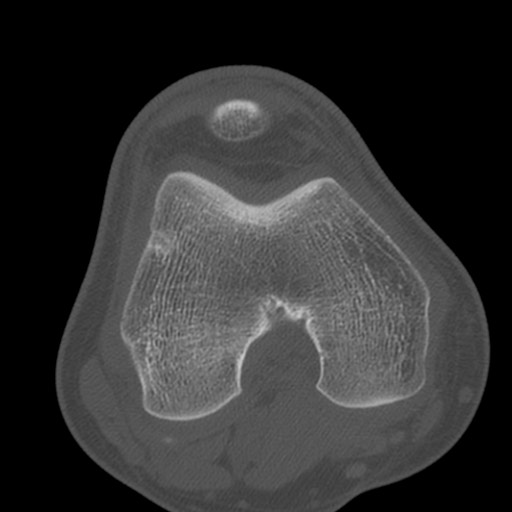 Brodie abscess of the tibia (Radiopaedia 58984-66250 Axial bone window 41).jpg