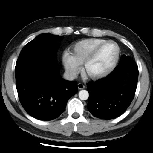 Bronchial carcinoid tumor (Radiopaedia 67377-76764 A 44).jpg