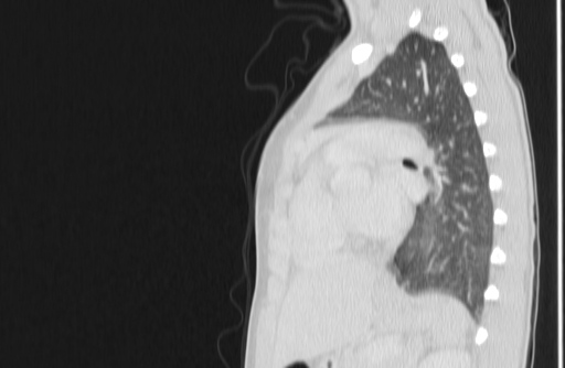 Bronchial mucoepidermoid carcinoma (Radiopaedia 57023-63895 Sagittal lung window 118).jpg
