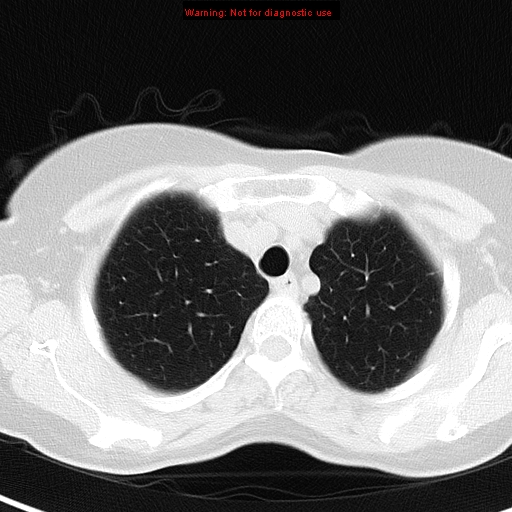 File:Bronchoalveolar carcinoma (BAC) (Radiopaedia 13436-13392 Axial lung window 9).jpg