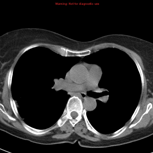File:Bronchoalveolar carcinoma (BAC) (Radiopaedia 13436-13392 Axial non-contrast 25).jpg