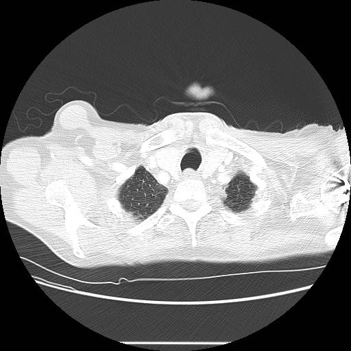 Bronchocele (Radiopaedia 17097-16795 Axial lung window 11).jpg