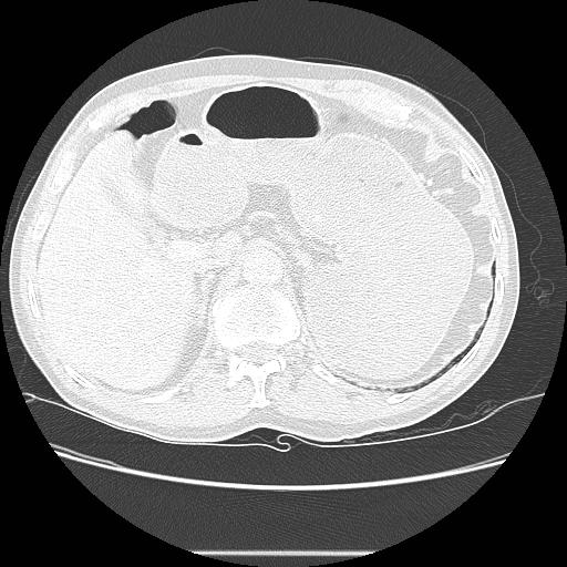 File:Bronchocele (Radiopaedia 17097-16795 Axial lung window 116).jpg