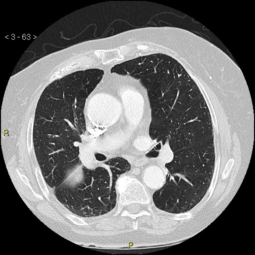 File:Bronchogenic carcinoma as an incidental finding (Radiopaedia 16453-16130 Axial lung window 63).jpg