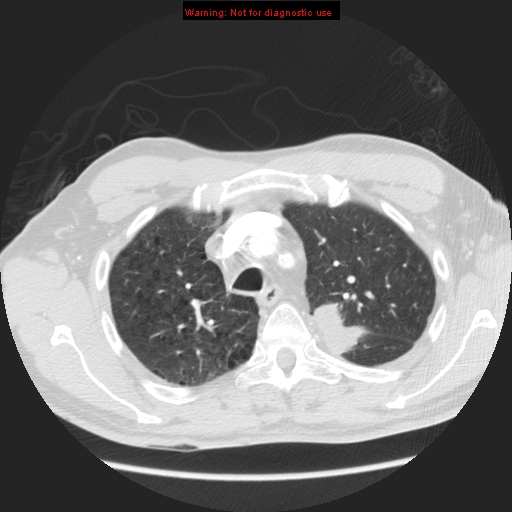 File:Bronchogenic carcinoma brain metastasis (Radiopaedia 9286-105832 Axial lung window 23).jpg