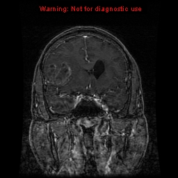 File:Bronchogenic carcinoma brain metastasis (Radiopaedia 9286-9969 Coronal T1 28).jpg