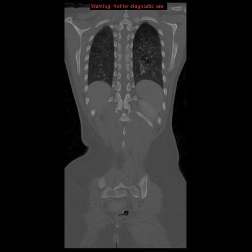 File:Brown tumor (Radiopaedia 12318-12596 D 53).jpg