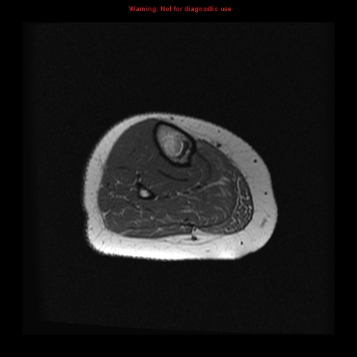 File:Brown tumor (Radiopaedia 12318-12597 Axial T1 26).jpg