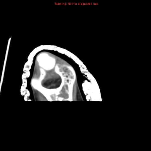 Brown tumor (Radiopaedia 12460-12694 Axial non-contrast 142).jpg