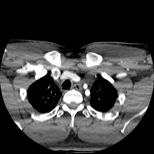Buccal fat pad arteriovenous malformation (Radiopaedia 70936-81144 D 21).jpg