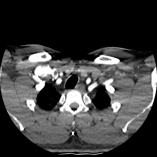 Buccal fat pad arteriovenous malformation (Radiopaedia 70936-81144 D 36).jpg