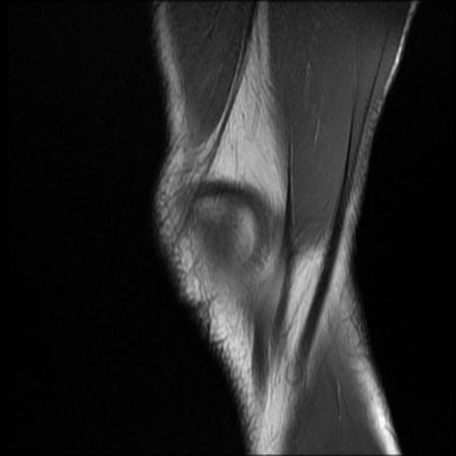 File:Bucket handle tear - medial meniscus (Radiopaedia 69245-79026 Sagittal T1 18).jpg
