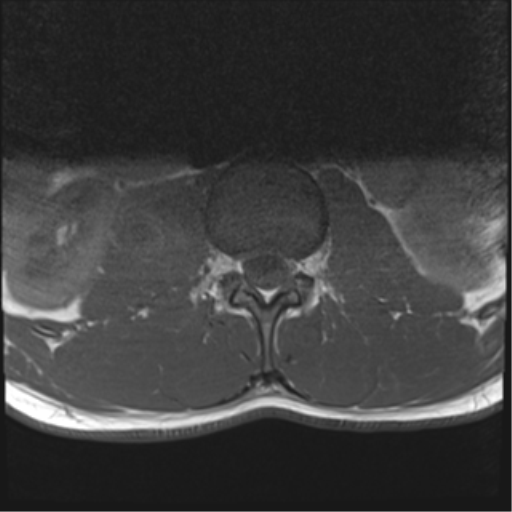 File:Burst fracture - T12 with conus compression (Radiopaedia 56825-63646 Axial T1 3).png