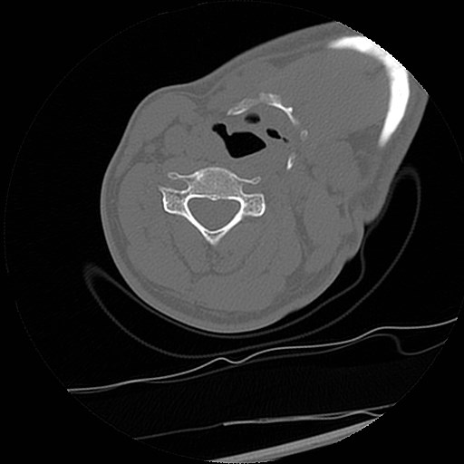 C1-C2 "subluxation" - normal cervical anatomy at maximum head rotation (Radiopaedia 42483-45607 Axial non-contrast 5).jpg