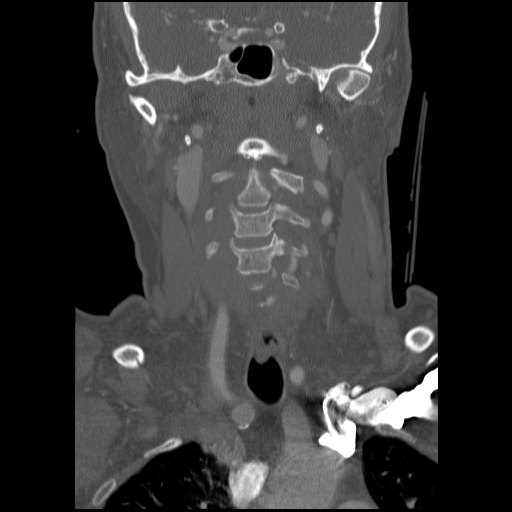 C1 anterior arch (plough) fracture - type 1 (Radiopaedia 76181-87720 Coronal bone window 63).jpg