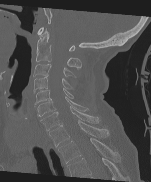 C2 fracture with vertebral artery dissection (Radiopaedia 37378-39199 Sagittal bone window 39).png