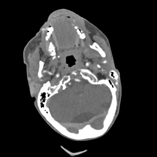 File:C2 fracture with vertebral artery dissection (Radiopaedia 37378-39200 A 190).png