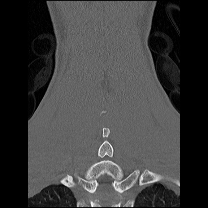 C5 facet fracture (Radiopaedia 58374-65499 Coronal bone window 48).jpg