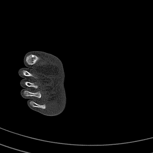 Calcaneal fracture - Sanders type 4 (Radiopaedia 90179-107370 Axial bone window 63).jpg
