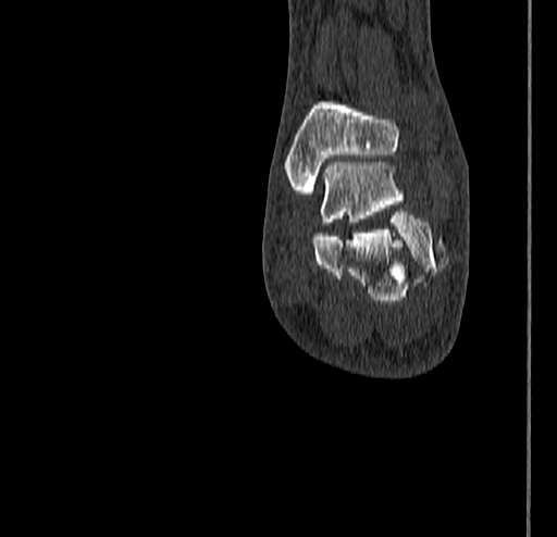 Calcaneal fracture - Sanders type 4 (Radiopaedia 90179-107370 Coronal bone window 71).jpg