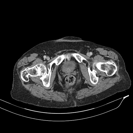 Calcified adrenal glands and Spigelian hernia (Radiopaedia 49741-54988 A 242).jpg