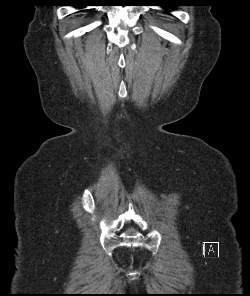 Calcified adrenal glands and Spigelian hernia (Radiopaedia 49741-54988 B 110).jpg