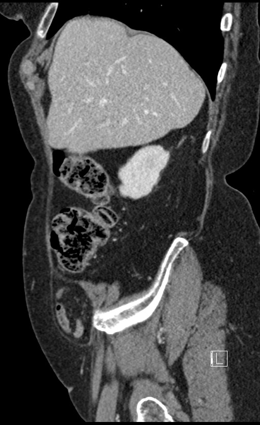 Calcified adrenal glands and Spigelian hernia (Radiopaedia 49741-54988 C 131).jpg
