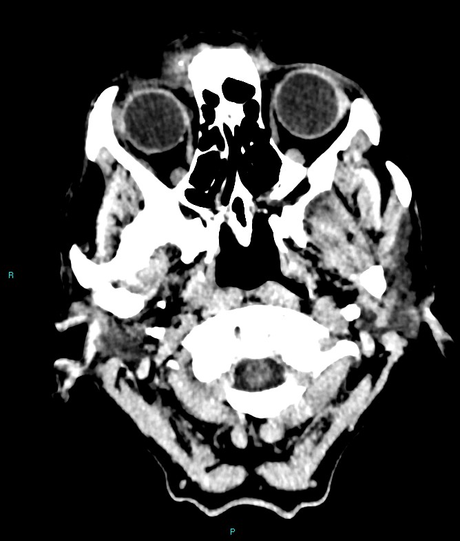 Calcified cerebral emboli from left ventricular thrombus (Radiopaedia 84420-99758 Axial non-contrast 86).jpg