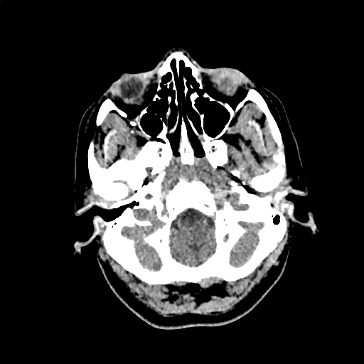 File:Calcified cerebral hydatid cyst (Radiopaedia 65603-74717 Axial non-contrast 2).jpg