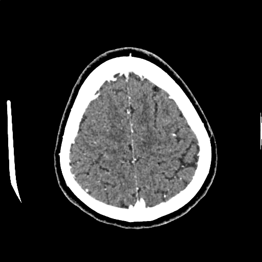 Calcified cerebral hydatid cyst (Radiopaedia 65603-74717 Axial with contrast 68).jpg