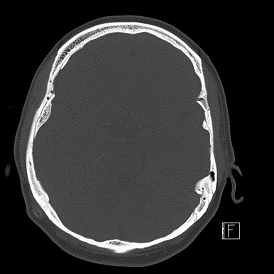 Calcified chronic subdural hematoma (Radiopaedia 77374-89492 Axial bone window 47).jpg