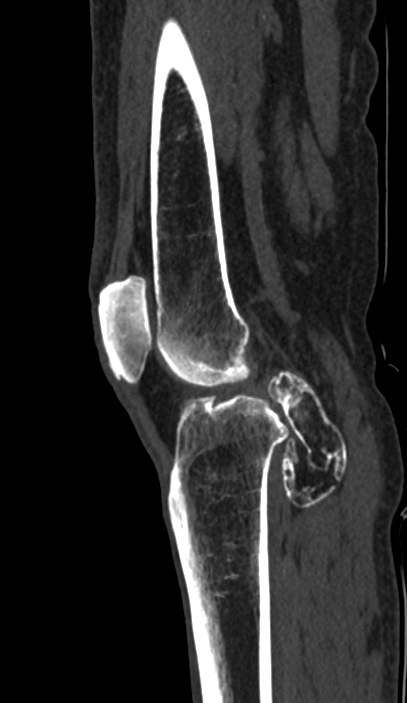 Calcified hematoma - popliteal fossa (Radiopaedia 63938-72763 Sagittal bone window 53).jpg