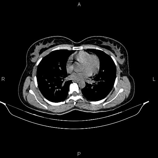 File:Calcified hepatic hydatid cyst (Radiopaedia 84672-100095 Axial non-contrast 2).jpg