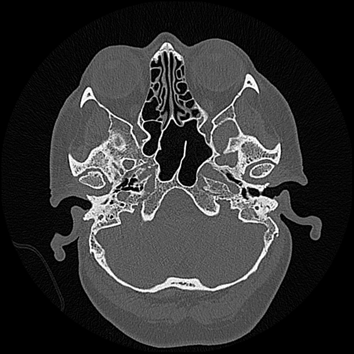 Canal up mastoidectomy (Radiopaedia 78108-90638 Axial bone window 46).jpg
