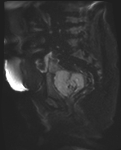 Cancer cervix - stage IIb (Radiopaedia 75411-86615 Sagittal DWI 58).jpg