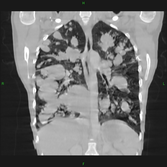 File:Cannon ball metastases - synovial sarcoma (Radiopaedia 26135-26271 Coronal lung window 11).jpg