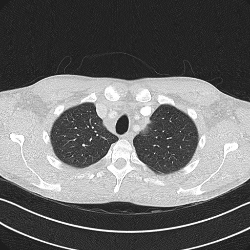 Cannonball metastases - testicular choriocarcinoma (Radiopaedia 84510-99891 Axial lung window 22).jpg