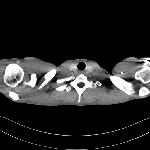 Cannonball metastases - testicular choriocarcinoma (Radiopaedia 84510-99891 B 12).jpg