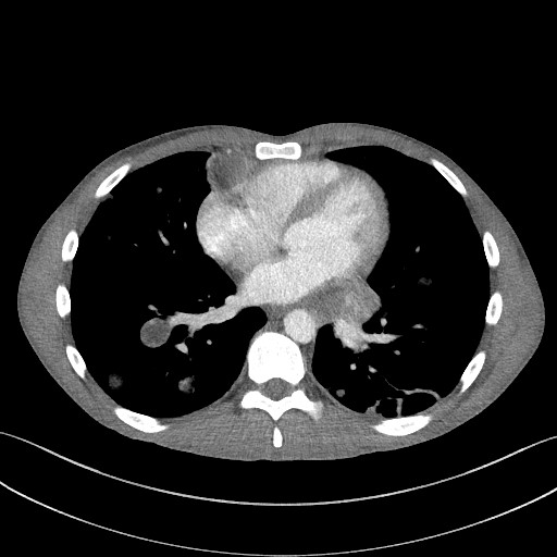 Cannonball metastases - testicular choriocarcinoma (Radiopaedia 84510-99891 B 72).jpg