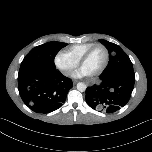 Cannonball metastases - testicular choriocarcinoma (Radiopaedia 84510-99891 B 78).jpg