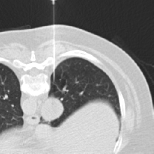 Carcinoid tumor - lung (Radiopaedia 44814-48644 Axial lung window 49).png