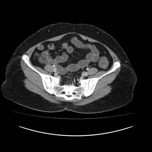 Carcinoma colon - hepatic flexure (Radiopaedia 19461-19493 A 98).jpg