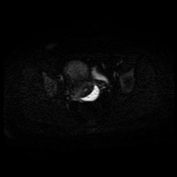 Carcinoma of the cervix (Radiopaedia 89018-105858 Axial DWI 34).jpg
