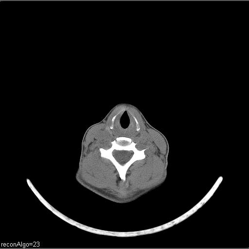 Carcinoma of the maxillary antrum (Radiopaedia 53805-59888 Axial non-contrast 24).jpg