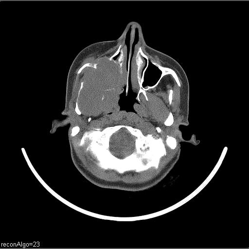 Carcinoma of the maxillary antrum (Radiopaedia 53805-59888 Axial non-contrast 59).jpg
