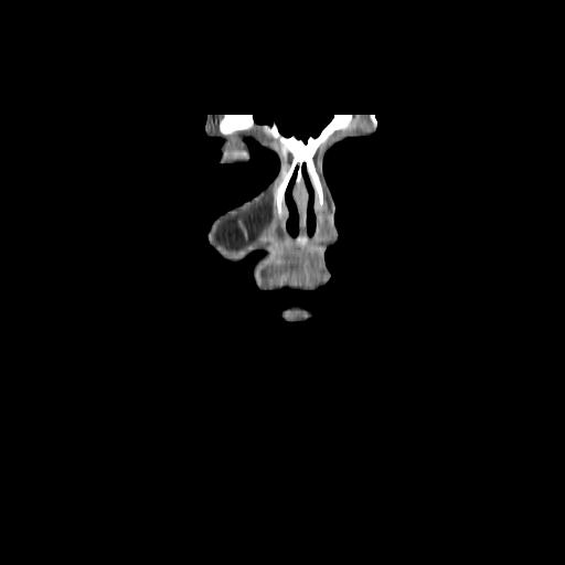 Carcinoma of the maxillary antrum (Radiopaedia 53805-59888 Coronal C+ delayed 2).jpg
