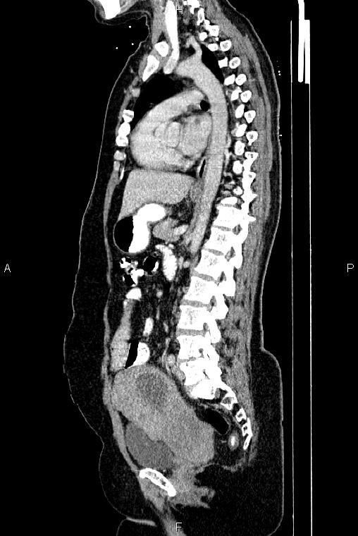 Carcinoma of uterine cervix (Radiopaedia 85861-101700 D 47).jpg